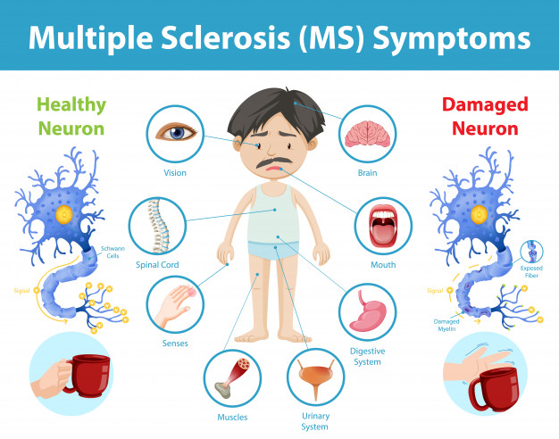 How Does Multiple Sclerosis Affect The Brain Spinal Cord And Immune 