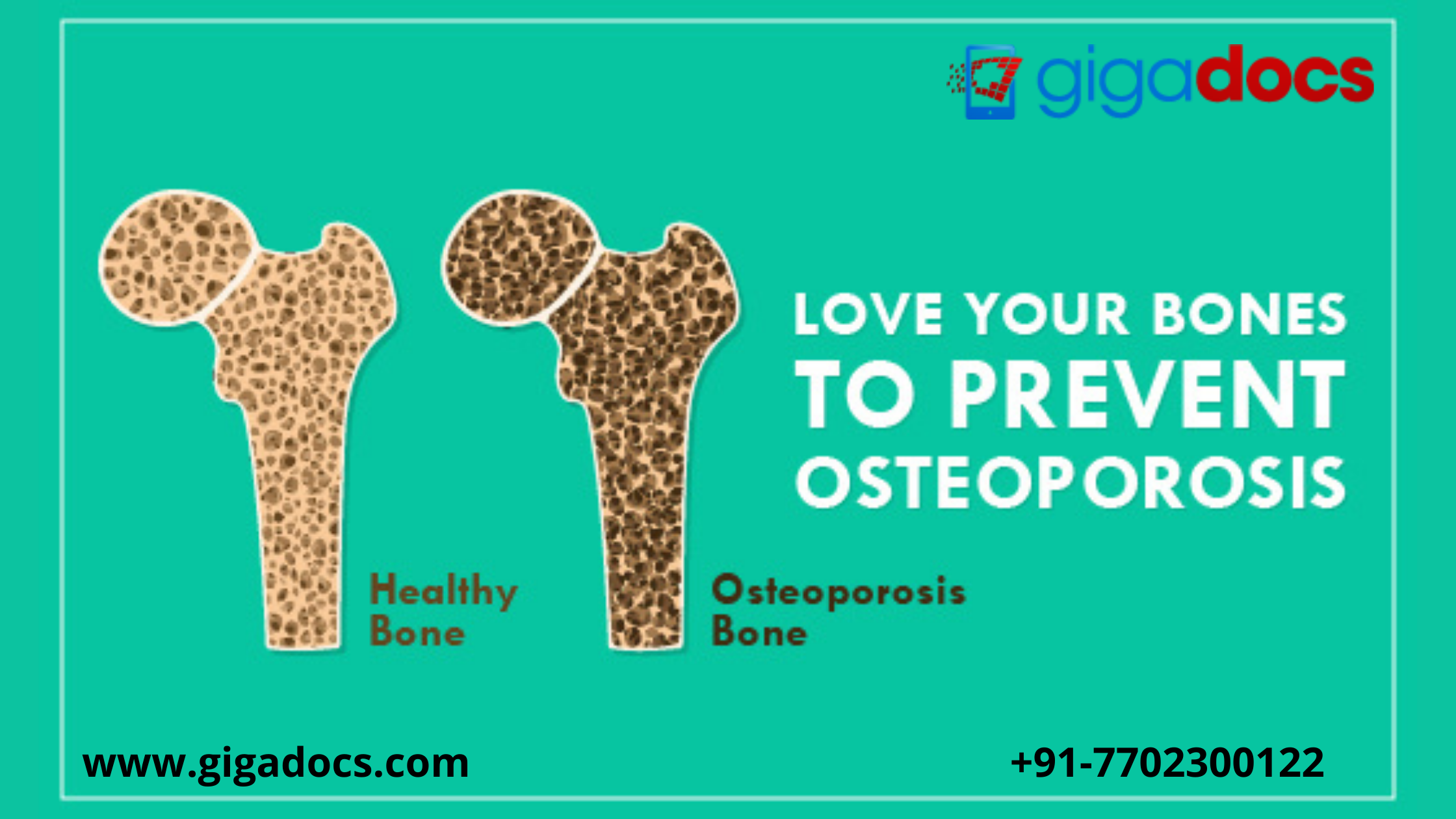 World Osteoporosis Day: Signs Of Osteoporosis, Vitamins For Bones, And ...